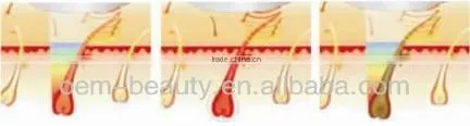 Salon equipment laser hair removal for sale