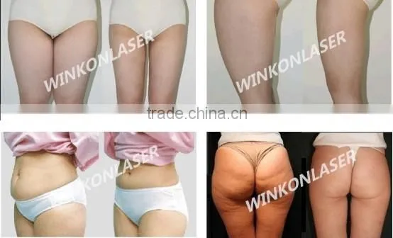 body shaping machine / cold lipolysis machine / lipolysis machine