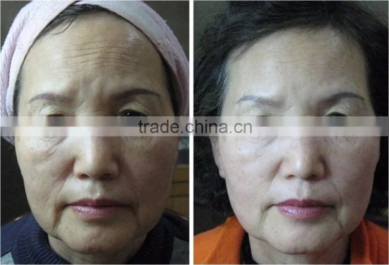 anti ageing machine korea HIFU face lifting LANGDI