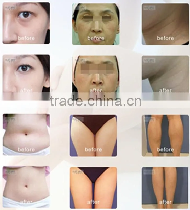 CE approved cavitation and rf laser slimming machine