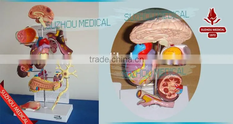 Effects of hypertension, 5 parts