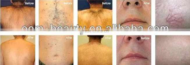 Painless Laser Hair Removal Machine epilator keyword