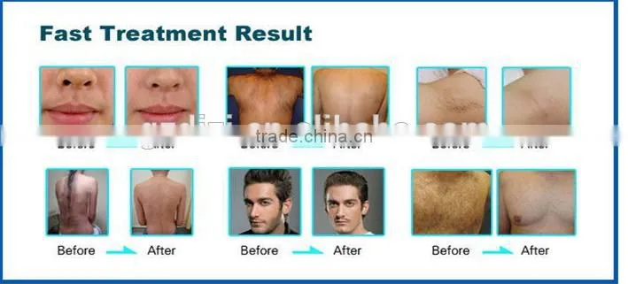 Professional ND YAG Laser Tattoo Eyebrow Removal Skin Whiten Rejuvenation Machine
