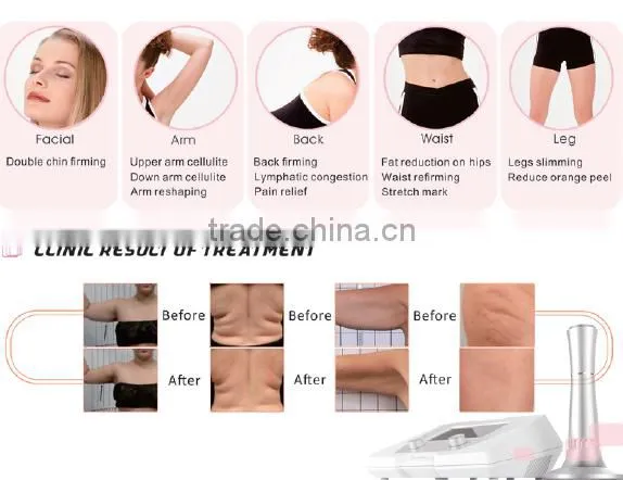 shockwave therapy machine for sale/acoustic wave therapy cellulite/treatment for cellulite slimming fat