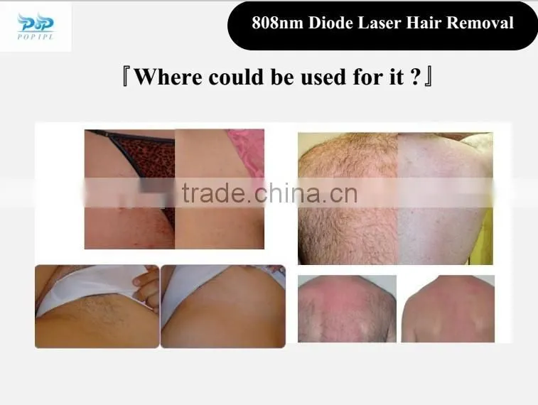 808nm diode laser machine treatment headpiecel Vertical 808nm diode laser machine for POPIPL