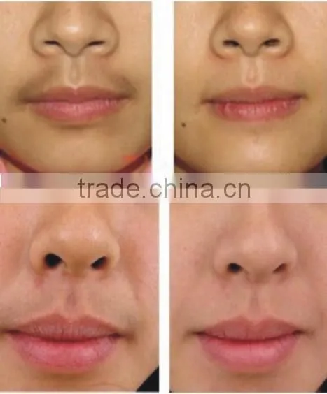 Beauty salon diode 808nm hair laser removal equipment
