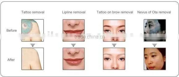 YUWEI-Q switch ND YAG Laser 1064nm 532nm tattoo removal laser machine
