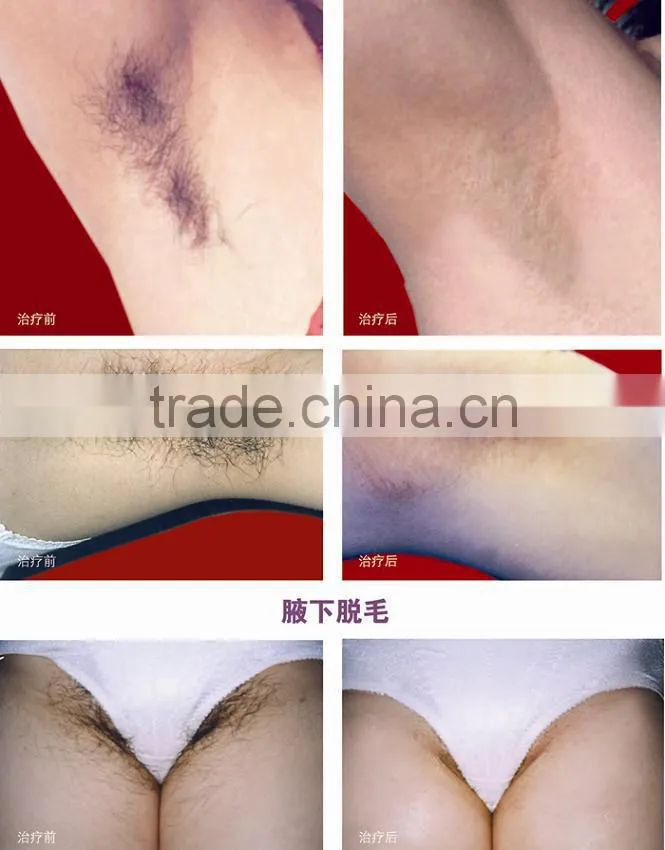 Multifunctional SHR IPL hair removal machine/best selling ipl e-light shr/hair removal system