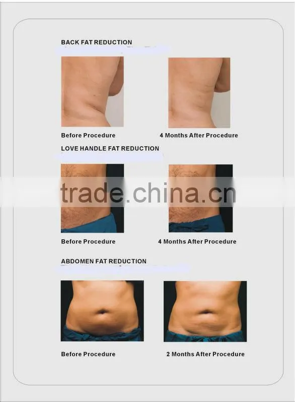 2015 new 4 in 1 fat freezing cooling rf slimming machine on sale