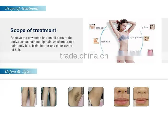 Top seller! depilacion laser 808 Diode body hair removers for man/ diode laser 808nm depilator
