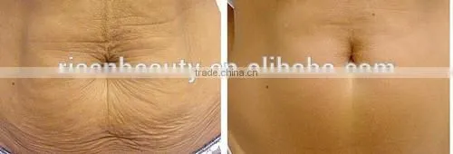 Power Line and Changeable Heads LED Light Microneedle Derma Rolling