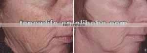 NL-TM800 High qualtiy face lift device thermagic cpt/thermagic rf machine