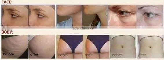 Multi function Vacuum RF Slimming Machine for body face eyes- F019
