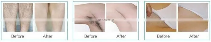 ipl laser machine/ hair removal/ Skin rejuvenation beauty equipment laser hair removal