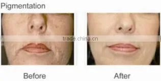Q switch nd yag laser skin age spot removal machine