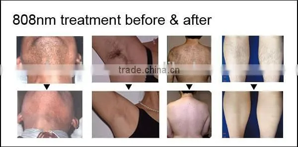 fast Diode laser hair removal