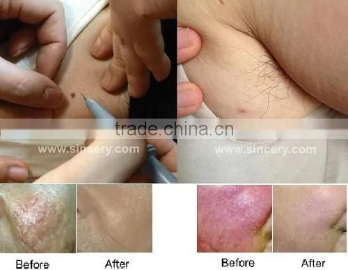 High quality portable vascular vein removal machine/spider vein removal