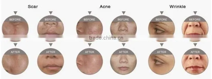 Hot selling !!! Vertical dot fractional co2 laser/laser co2 fractional vaginal equipment