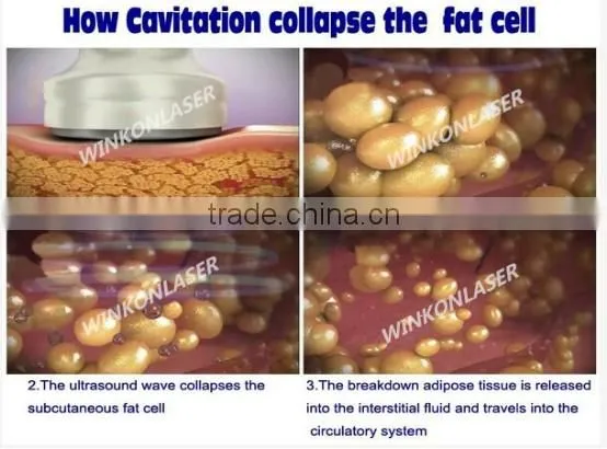 non-invasive liposuction machine / fat freezing machine / fat reducing machine
