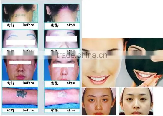 Clinic salon use tattoo removal q-switch tattoo removal machine