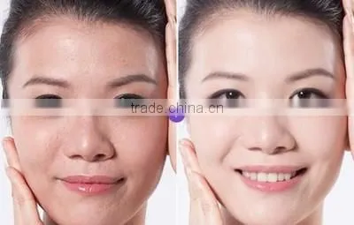 Best no needle cooling RF skin beauty machine for home use