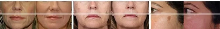 portable vacuum suction blackhead removal dermic diamond tip peel microdermabrasion machine for sale