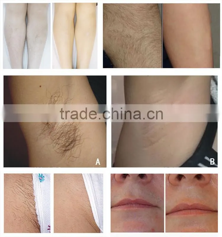 Latest powerful Germany 808 diode laser hair removal IPL shr permanent hair removal machine