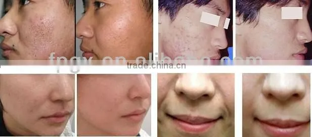 Top grade latest ipl rf beauty equipment is sale