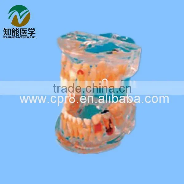 Transparent baby teeth pathological model BIX - L1006