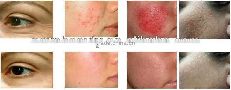 New Face NV- V500 2017 China supplier radio frequency neck lift rf equipment for skin tightening