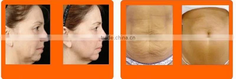 5MHZ RF for face lifting and skin tightening beauty instrument