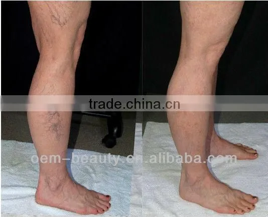 Big price cut ND yag laser equipment hair removal treatment