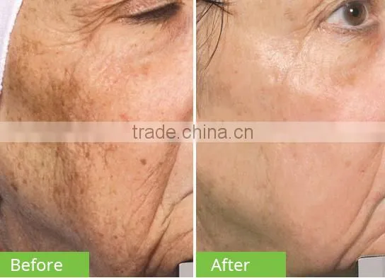 Multifunctional 4 in 1 Crystal diamond dermabrasion jet peel beauty machine water oxygen
