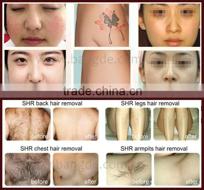Unique Feature OPT SHR/IPL/LASER Multifunction Hair Removal Machine