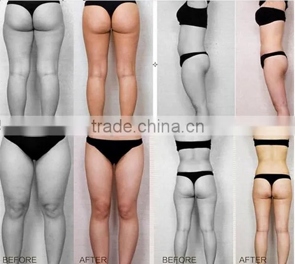 2016 On sale Vaccum roller Vela RF Shape body contour and weight loss slim Body fat removal Slim machine M10 eversun factory