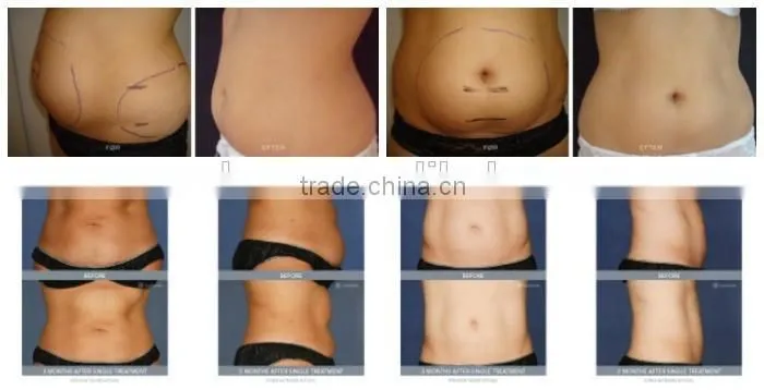 FDA medical High intensity focus ultrasound obesity machine Reduce