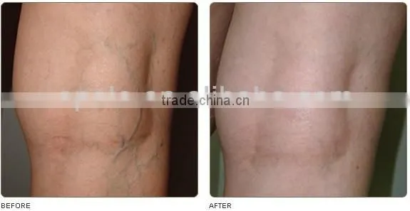 long pause ND:YAG laser hair removal varicose veins spider vein removal machine HS-280 by shanghai med.apolo
