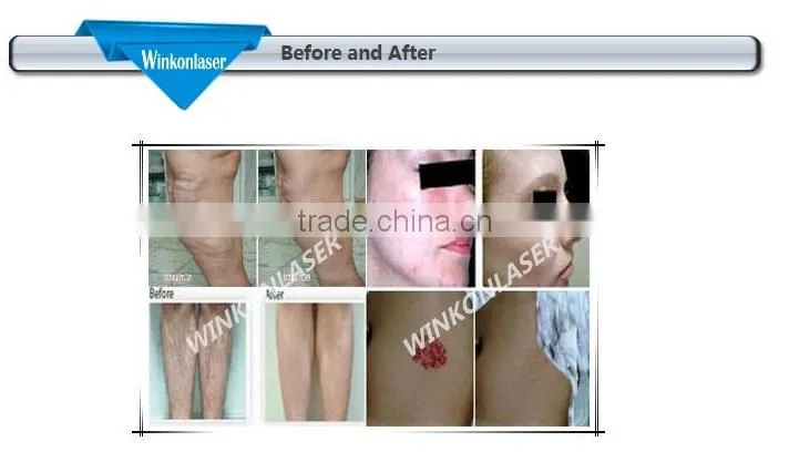 Multifunctional beauty machine! 1064nm long pulse laser for hair removal / skin rejunvenation