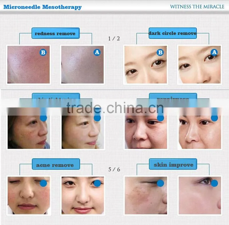 New Year Sale!!Size -0.5 mm Face Wrinkle Acne Derma Skin Microneedle Therapy Dermaroller