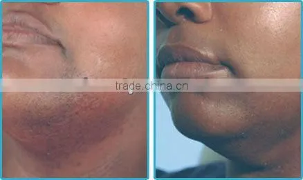 New hottest depilator laser 1064nm hair removing P001