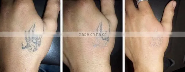 Vietnam distributor Cheap Yes Q-Switch and Laser Type q switched nd yag laser tattoo removal machine
