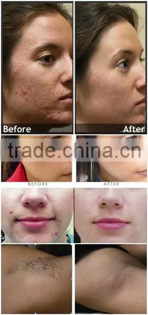 professional American crystal IPL painless hair removal Machine
