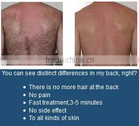Clinic Use hair removal and permanent hair reduction diode laser machine /808nm