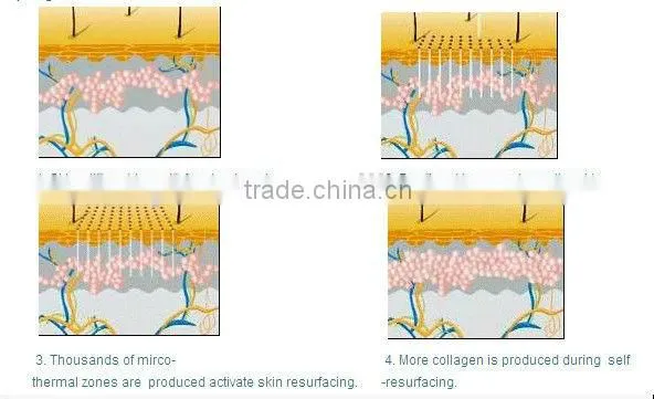 10600nm laser equipment co2 fractional