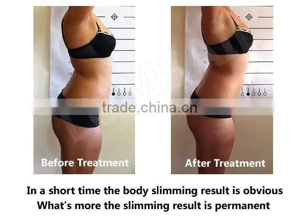 Mini skin freeze belt /portable mini cryotherapy fat freeze machine/cellulite therapy machine for home use