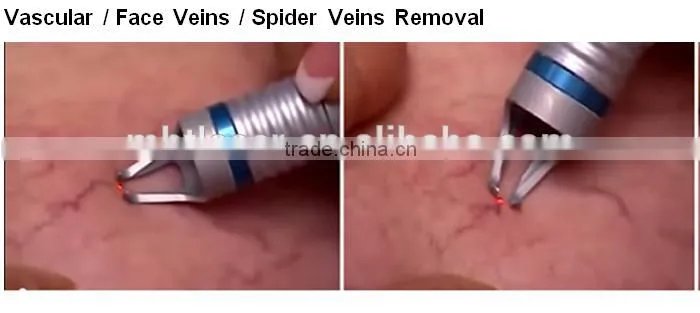 980nm vascular laser removal diode laser 980nm