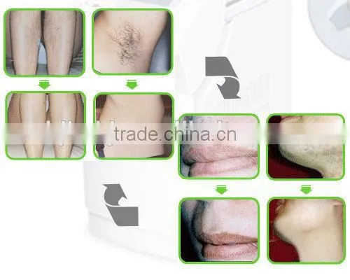 new speediness professional Home use IPL laser permanent hair removal machine