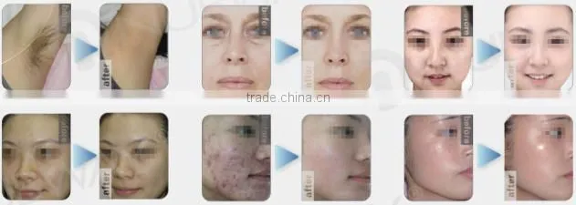 2015 newest IPL SHR beauty equipment Elos Laser Hair Removal Machine / SHR IPL