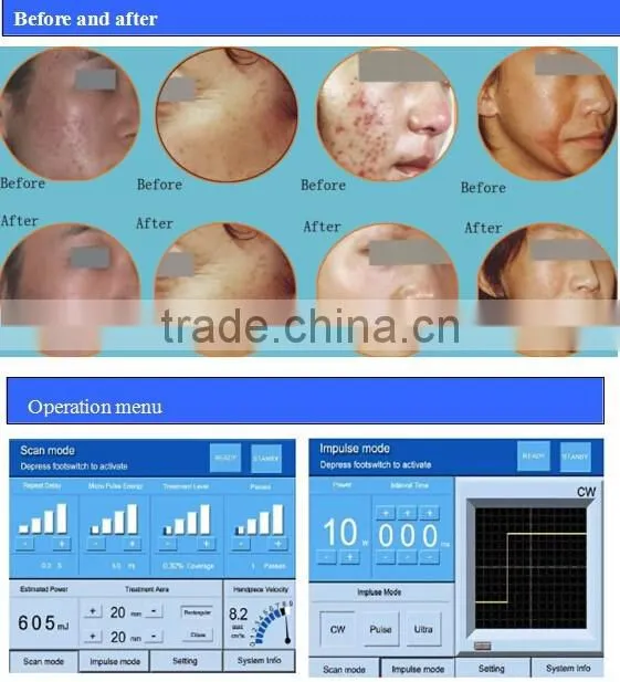 Erbium yag laser / Vaginal laser /Fractional CO2 laser