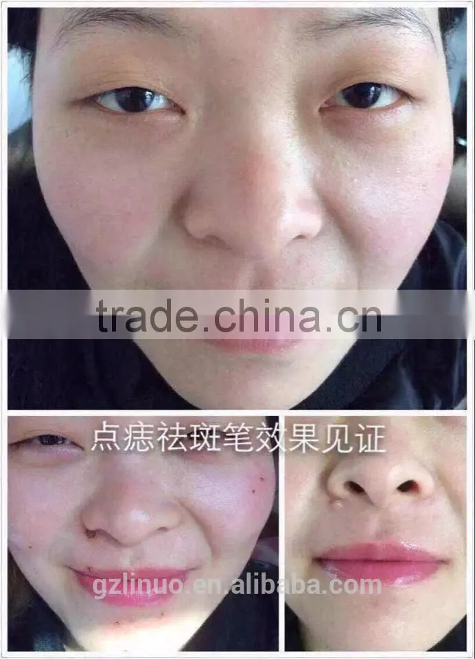 hand-held spot removal machine,high frequency current spot removal